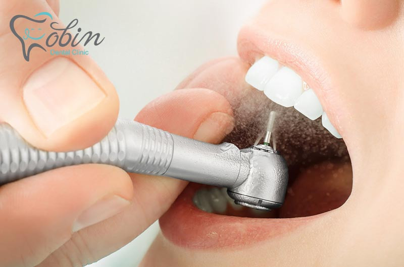 ممکن است فرایند ترمیم، نیاز به تراشیدن سطح دندان طبیعی داشته باشد.